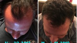 Regrow Hair Products – Before & After Pictures