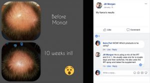 how to regrow hair on bald spot